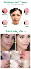 Moisturizing Acne Cream