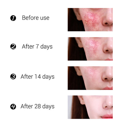 Moisturizing Acne Cream